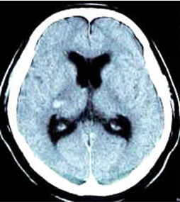 頭部CT画像
