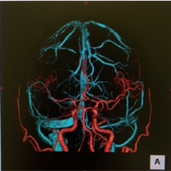 頭部血管3D画像