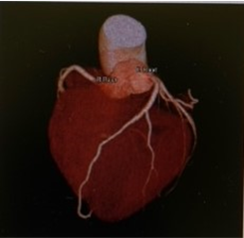 冠動脈（心臓）画像