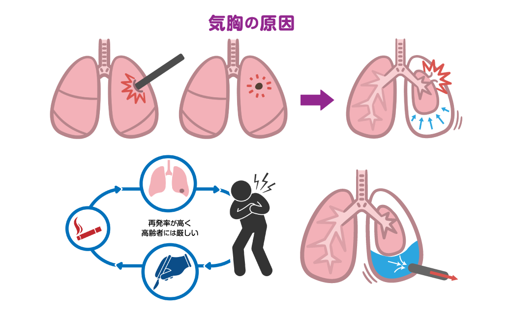 腰痛に手術が適しているのはいつですか?