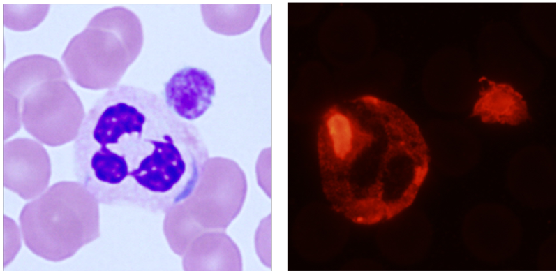 Neutrophil inclusion bodies and abnormal myosin IIA accumulation in MYH9 disorders.