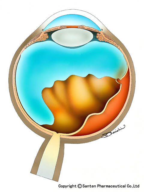 裂孔原性網膜剥離1