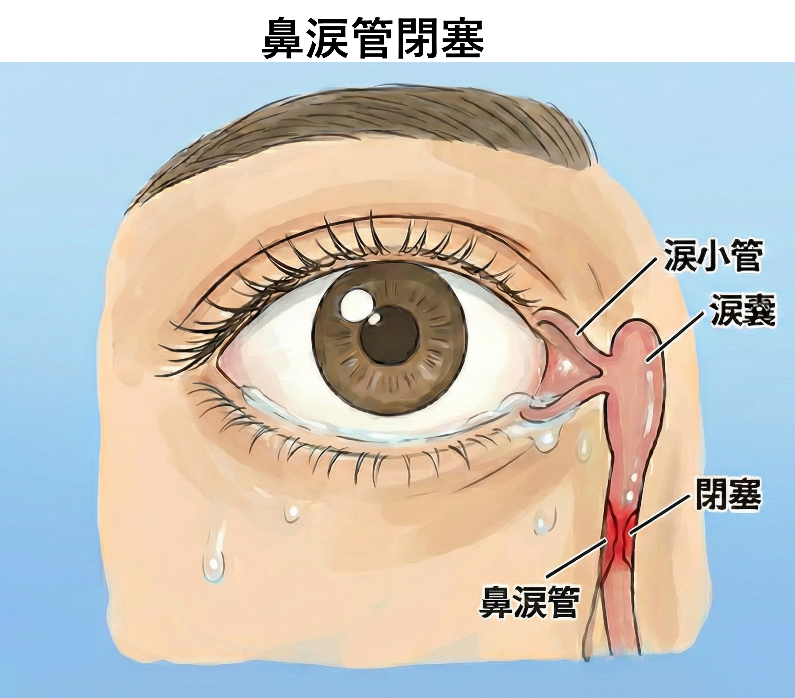 涙道疾患